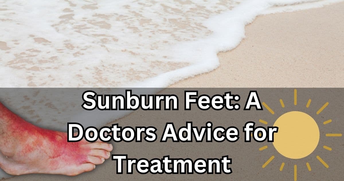 Sunburn of feet and its treatment